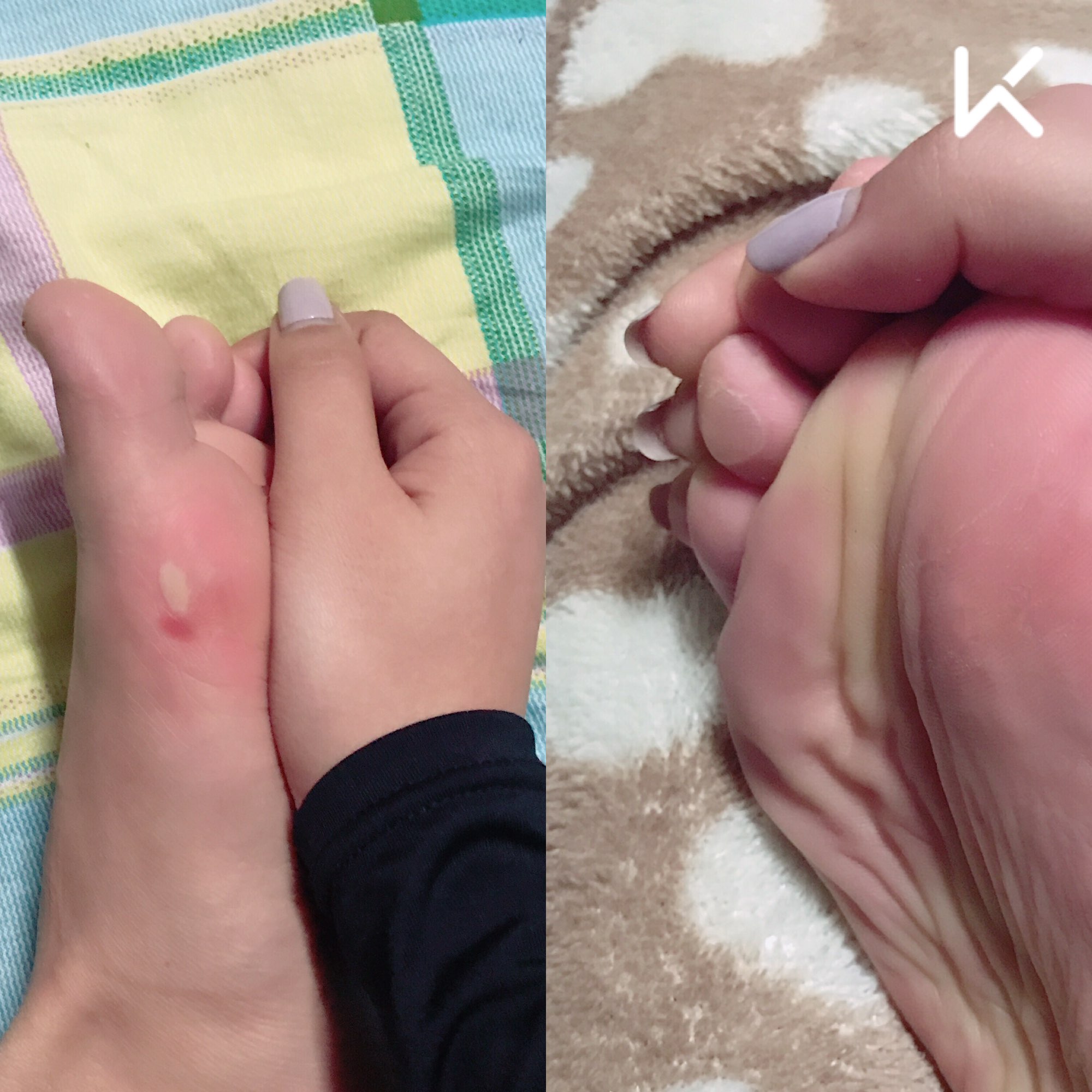 脚上全是跑步跑起来的水泡 可是还是想锻炼呢  立即参与  完成晨间