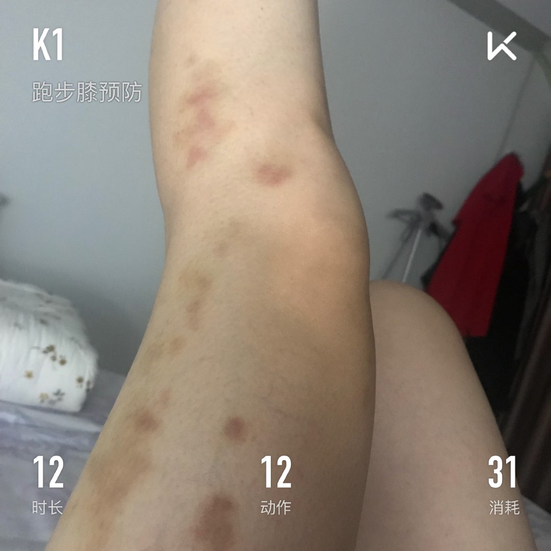 刮痧的腿,同事说会让人误认为遭到家暴了 立即参与  完成 跑步膝预防