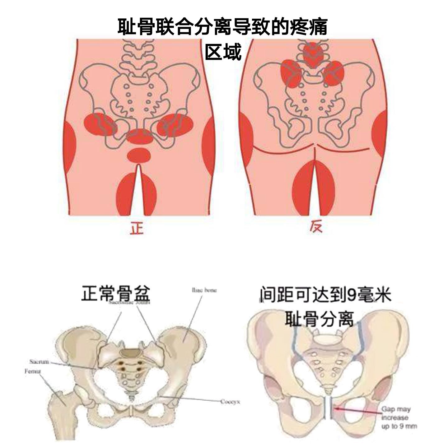 科学孕动 加剧孕期耻骨联合痛的五个不良习惯 四大缓解姿态 Keep