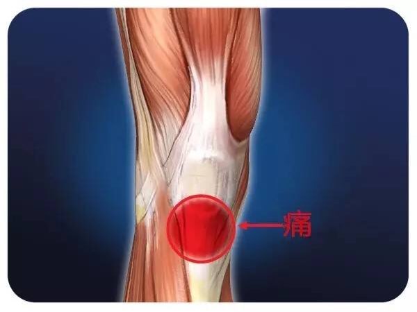 常见膝盖疼痛二—膝盖下方疼痛—髌腱炎髌腱炎又称跳跃膝(jumper