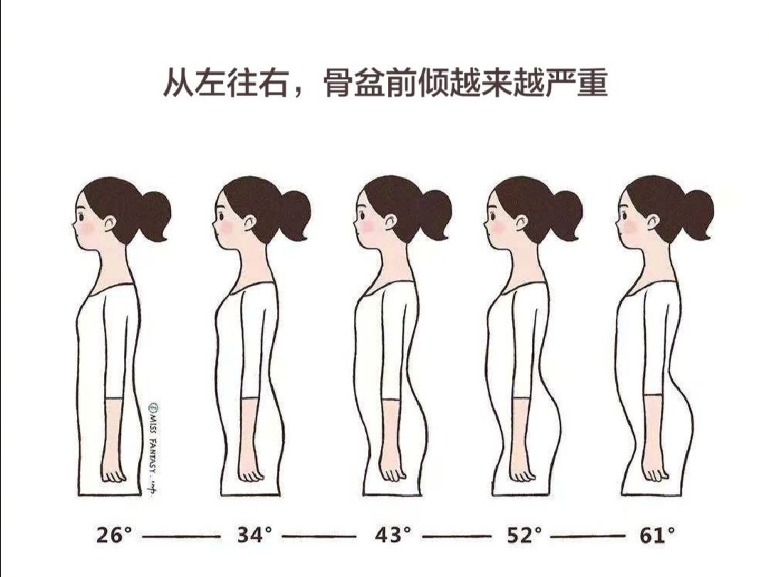 骨盆前倾是指骨盆向前病态的偏移,造成腰椎不正常的生理前凸.