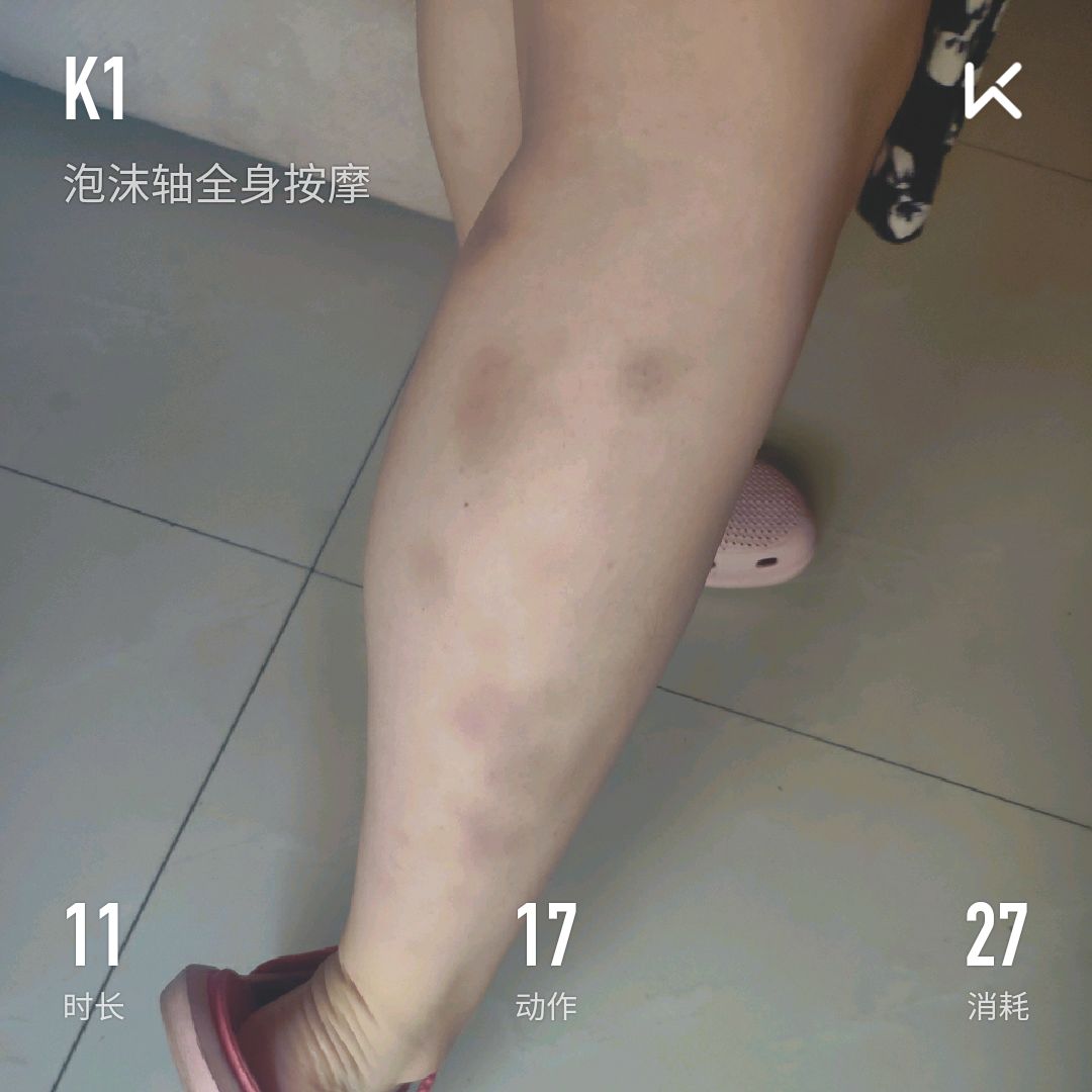 腿上的青紫由点状变成了片状,啥时候才能好啊而且运动了这么久小腿