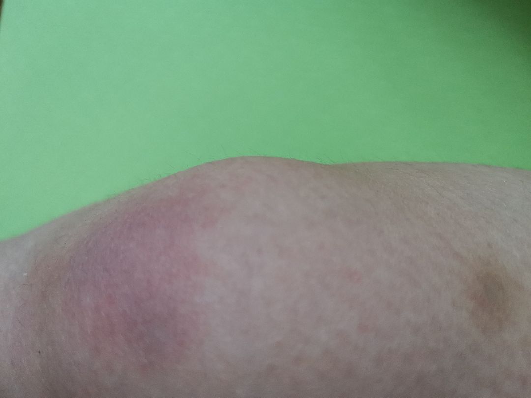 完成 健身球紧致腰腹 第2次 摔紫了膝盖[笑哭]