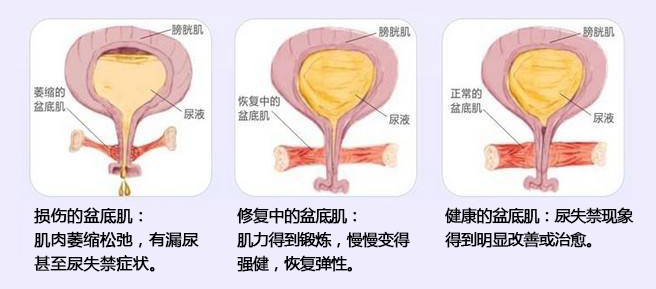 尿失禁分类图片