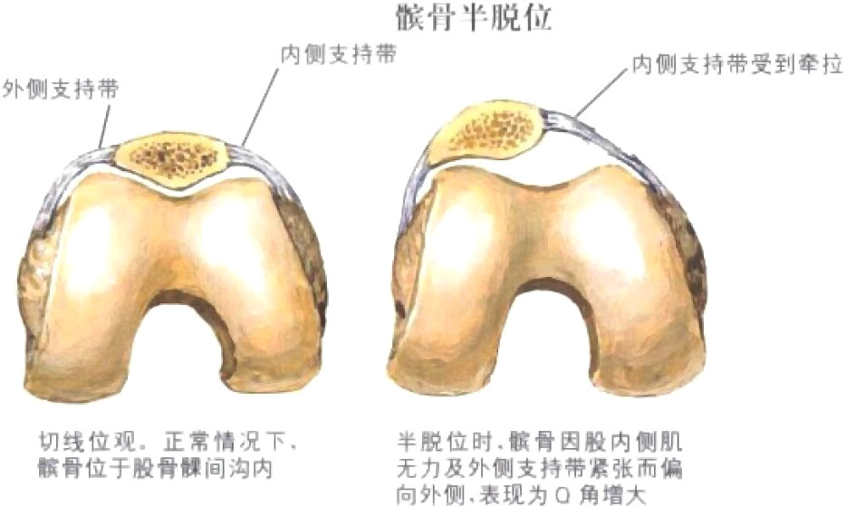 运动导致膝关节慢性疼痛的应对方案