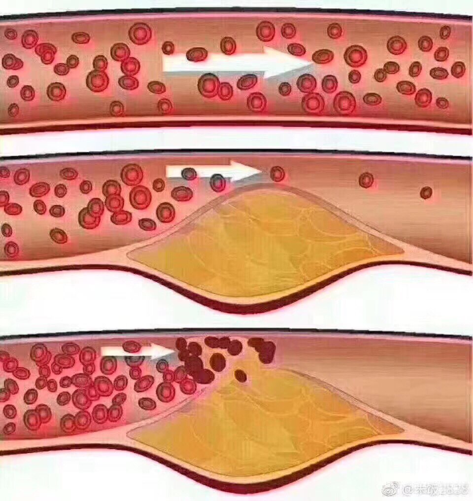 为什么一定要减肥6315最下边的是胖人的血管6015黄色的就是