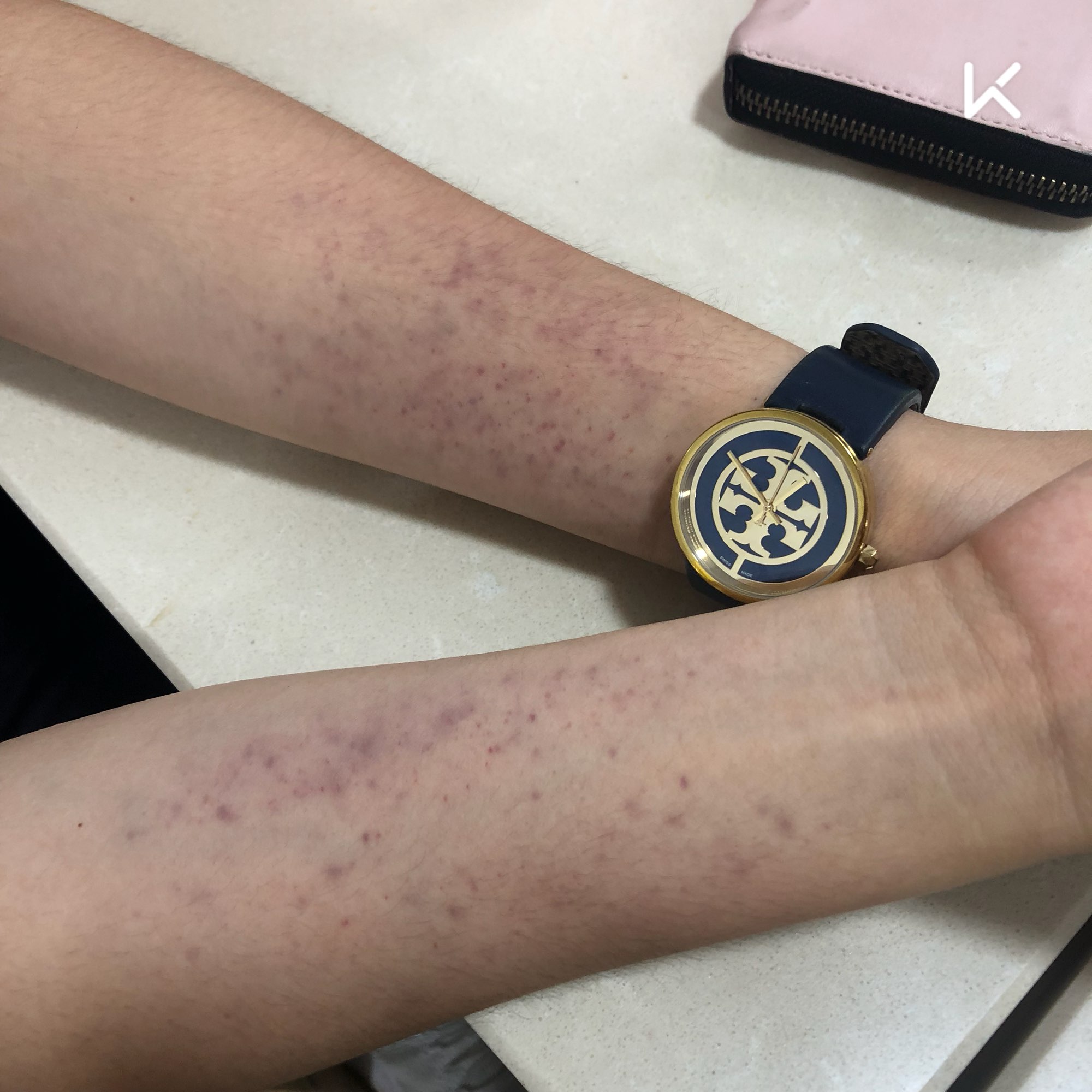 手臂线条越来越明显还是管不住自己嘴巴,今天体育课打排球居然淤青了