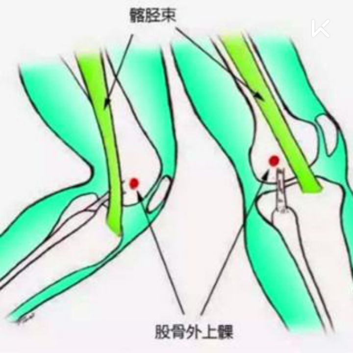 髂胫束综合症怎么治疗图片