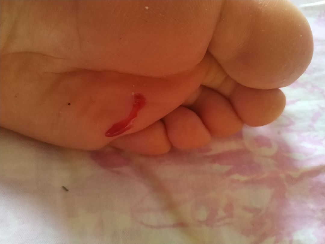 佩琪的胳膊扎到脚了.很多运动暂时不能做.