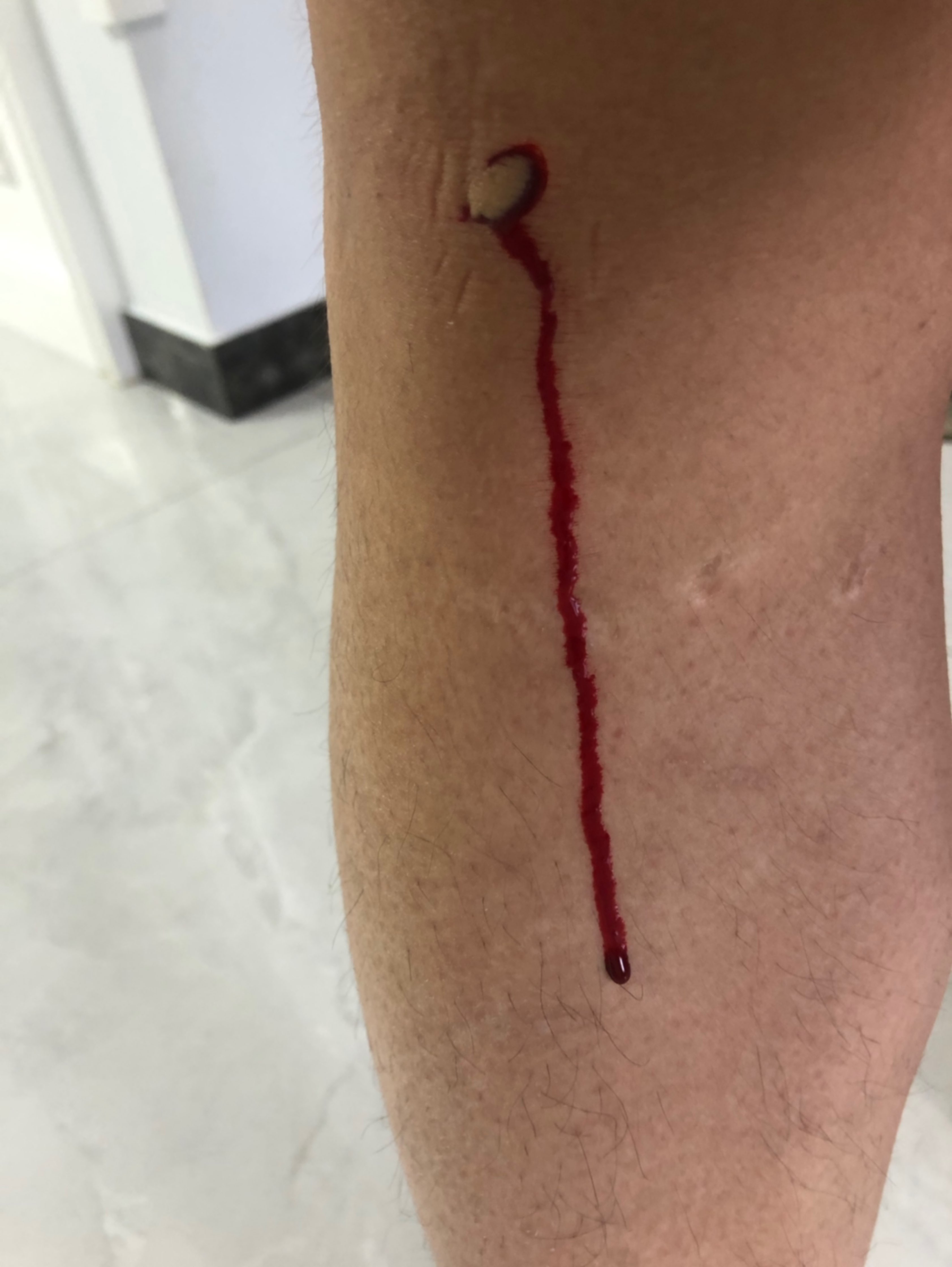 干活把腿弄伤了[流泪]这次好了可以继续跑步了94_keep