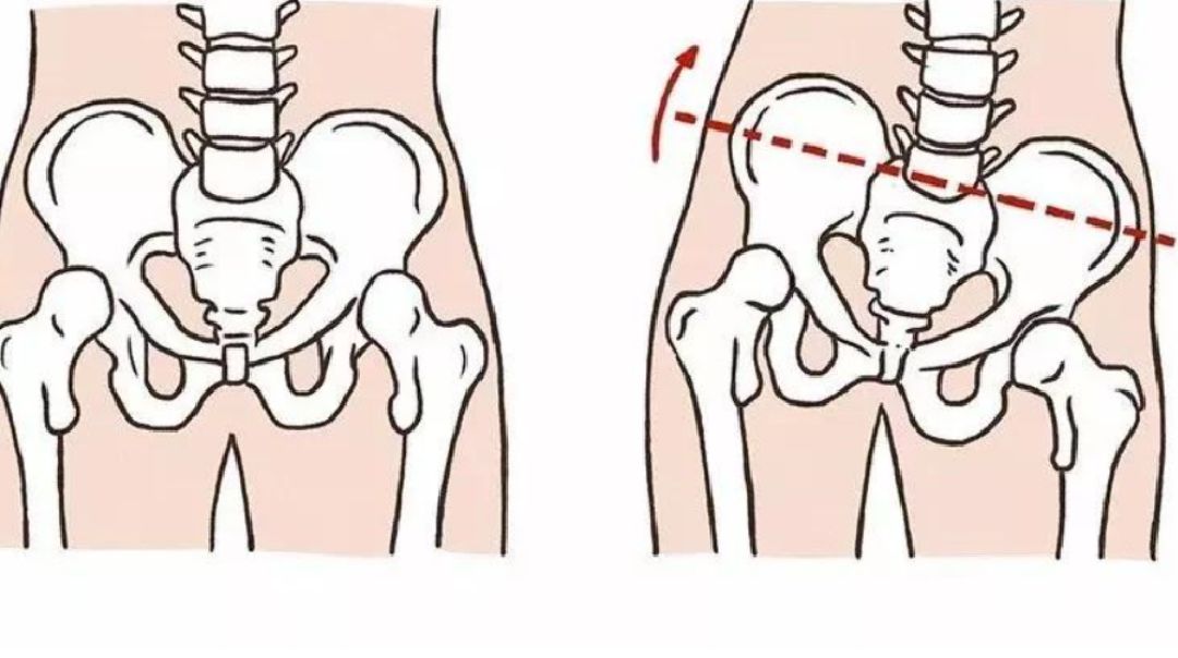 有高低骨盆_keep