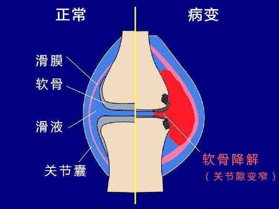 昨天跑步的时候,膝盖一点都没感觉不舒服,可是跑后它就酸了,尤其是单