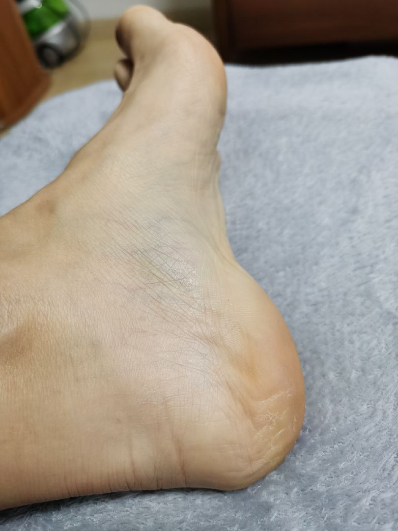 这两天冻的我脚后跟开裂了你们的脚都还好吗